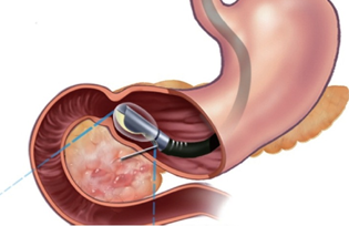 Endosonography