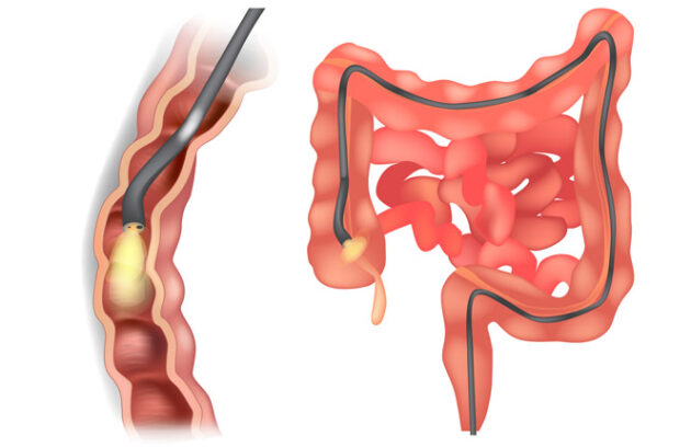 Endoscopy