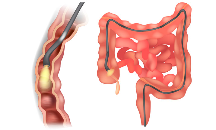 Endoscopy