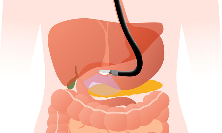 Endoscopy