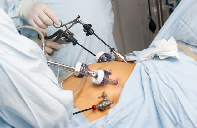 Bariatric-Surgery