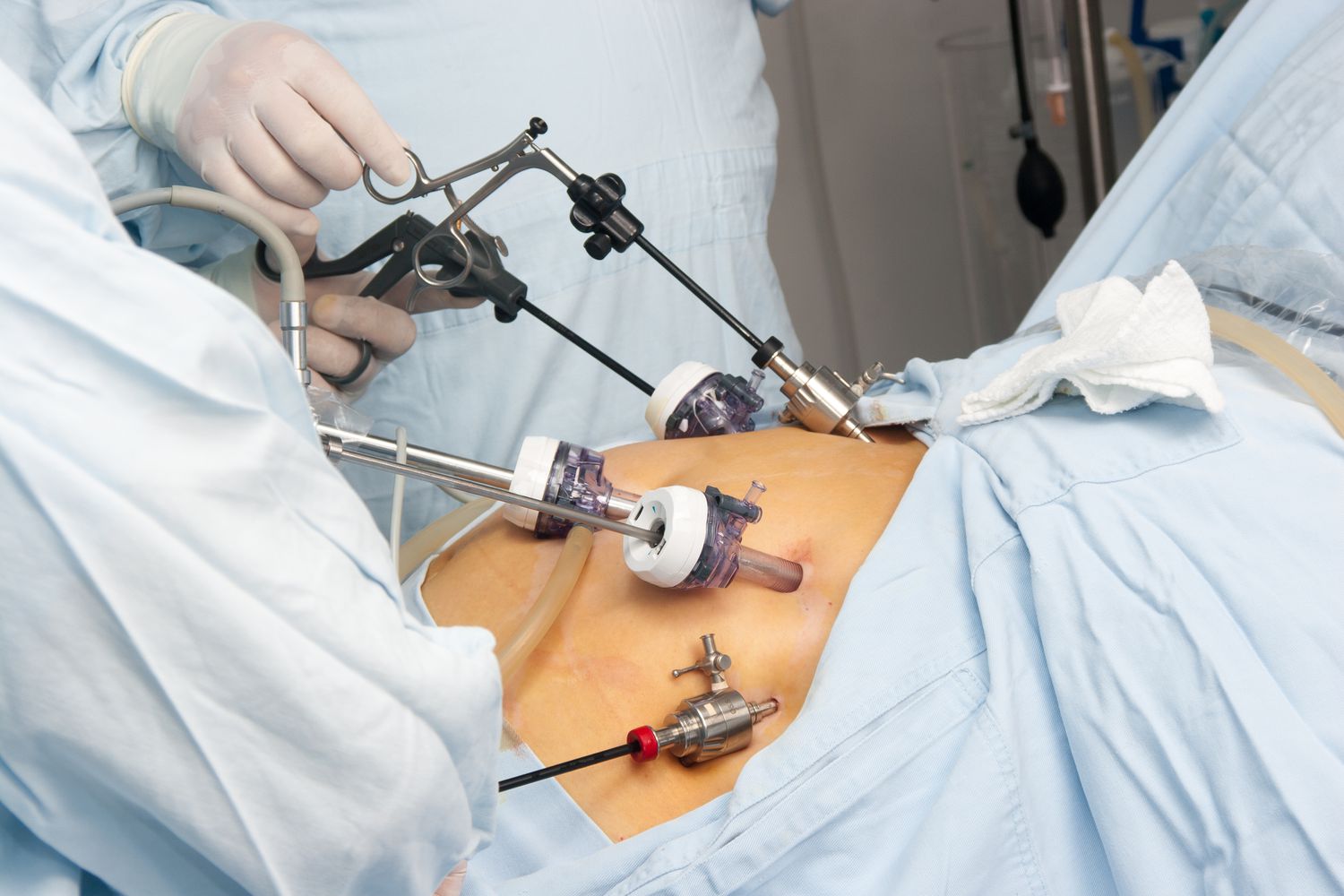 Bariatric-Surgery