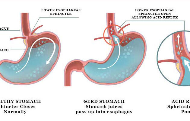 acid-reflux-GERD