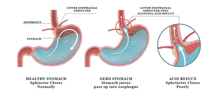 acid-reflux-GERD