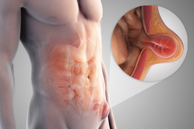 Hernia