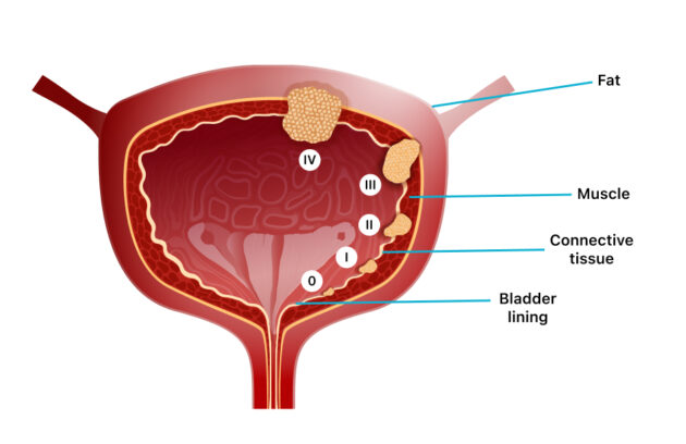 Bladder tumor awareness illustration – Gastrohub Hospital
