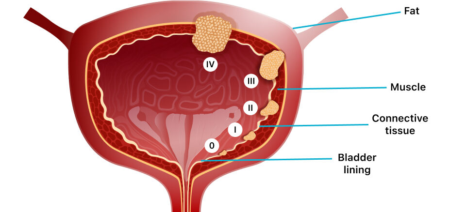 Bladder tumor awareness illustration – Gastrohub Hospital